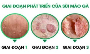 10 Bệnh viện Phòng Khám chữa sùi mào gà tại TP.HCM và Hà Nội - Trung tâm  Nghiên cứu Phát triển Y tế Cộng đồng (CCRD)