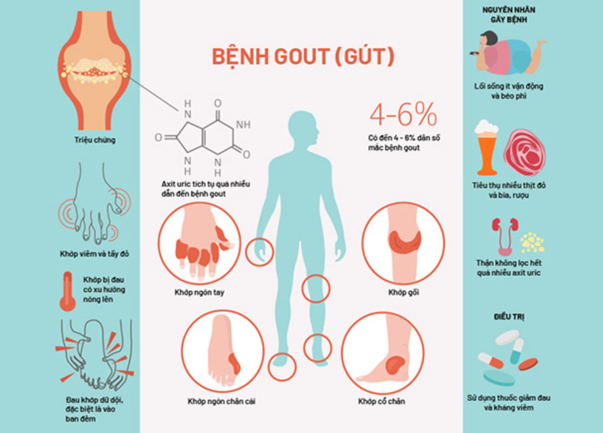 can benh gout