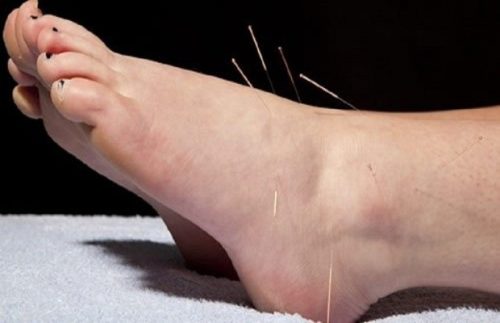 Cách chữa gai gót chân bằng liệu pháp Châm cứu