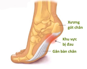 Cách chữa gai gót chân bằng Đông Y