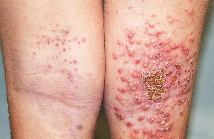 bệnh chàm (eczema) là gì