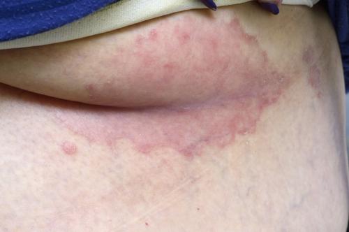 c0166868-inverse-psoriasis-science-photo-library-high_vi