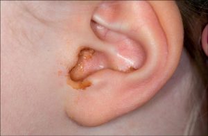 mẹo chữa viêm tai giữa